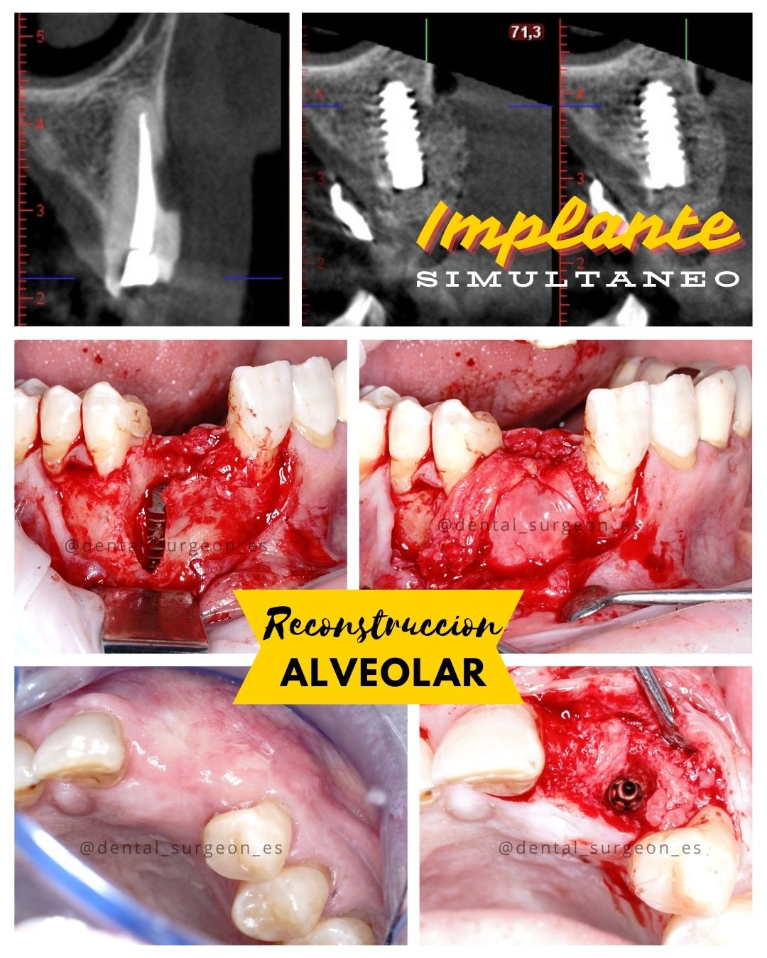 Regeneración ósea alveolar e implante inmediato en canino superior: estratificación e injerto pediculado rotado de paladar
