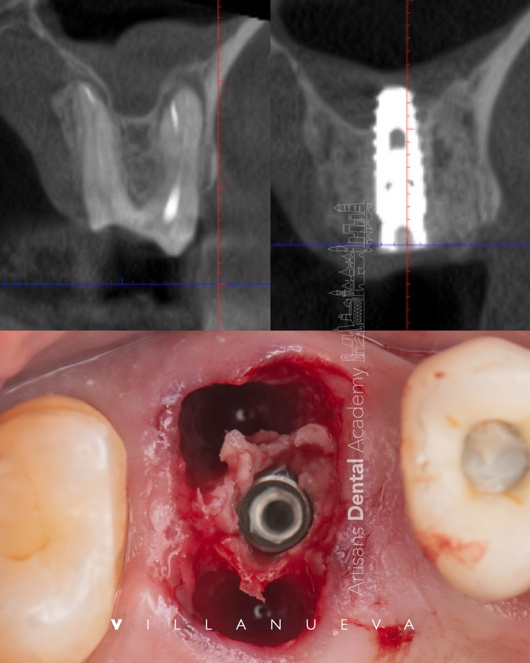 Implantes inmediatos en sector posterior: el valor de la mano alzada