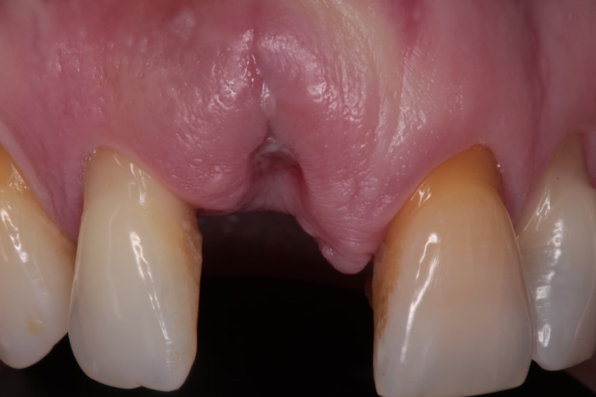 Implantes inmediatos tras avulsión traumática del 1.1: reconstrucción alveolar y provisionalización con los propios dientes