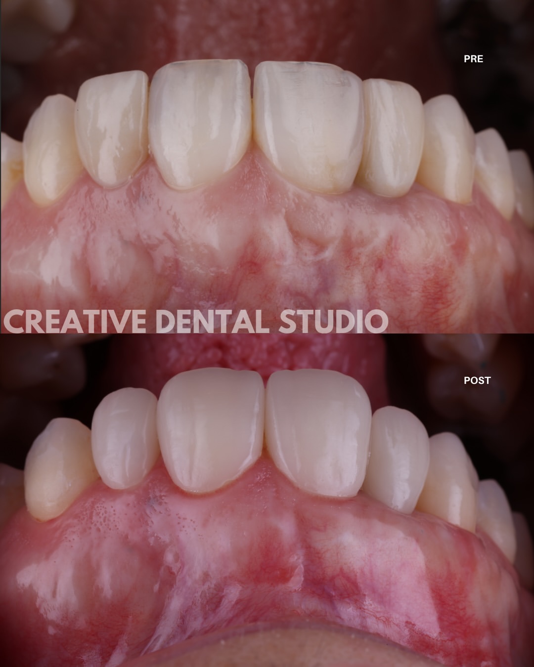 Armonía entre estética blanca y rosa: extrusión ortodóntica, injerto de conectivo alrededor del implante en 12 y restauración del frente anterior