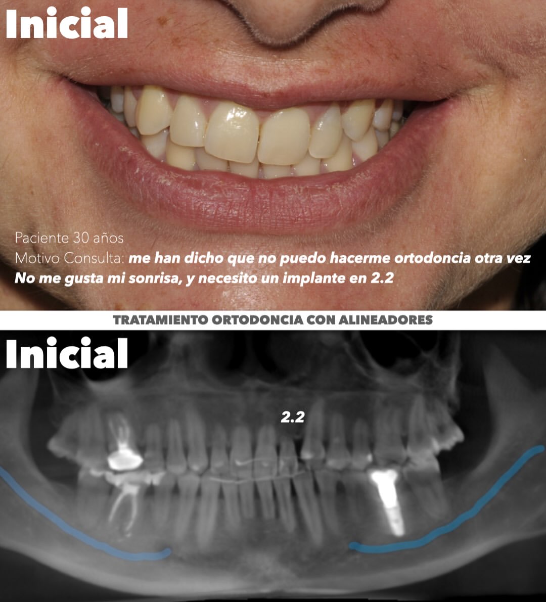 Retratamiento de ortodoncia con alineadores en una reabsorción radicular externa severa: mover sin perder los dientes
