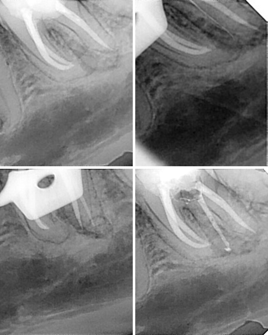 Sintomatología apical por omisión de un radix entomolaris en el 3.6