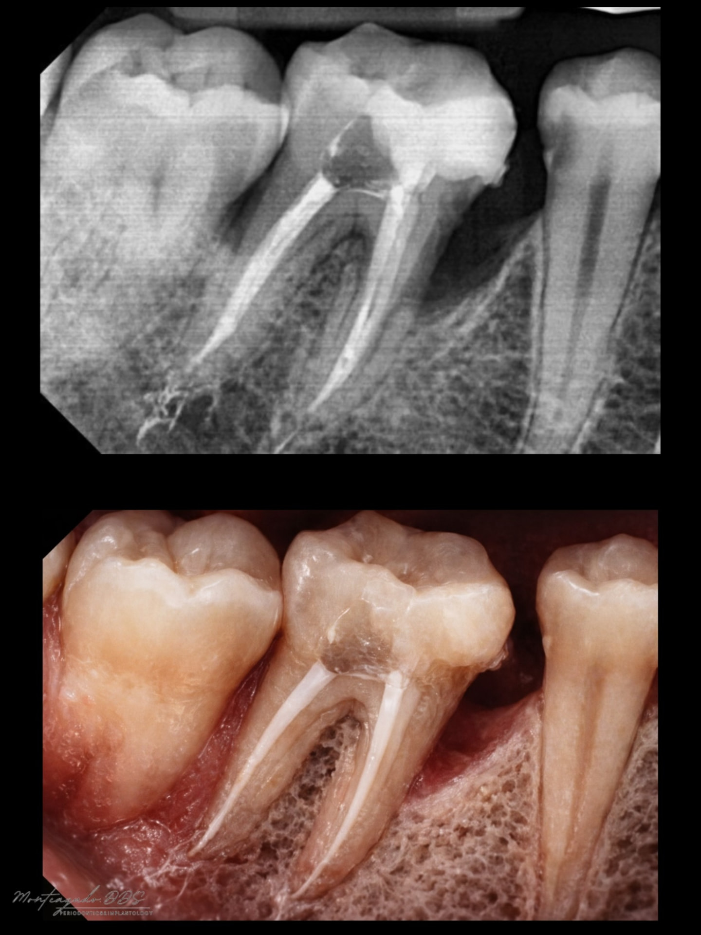 Regeneración periodontal de un defecto intraóseo de una pared con MIST y EMD