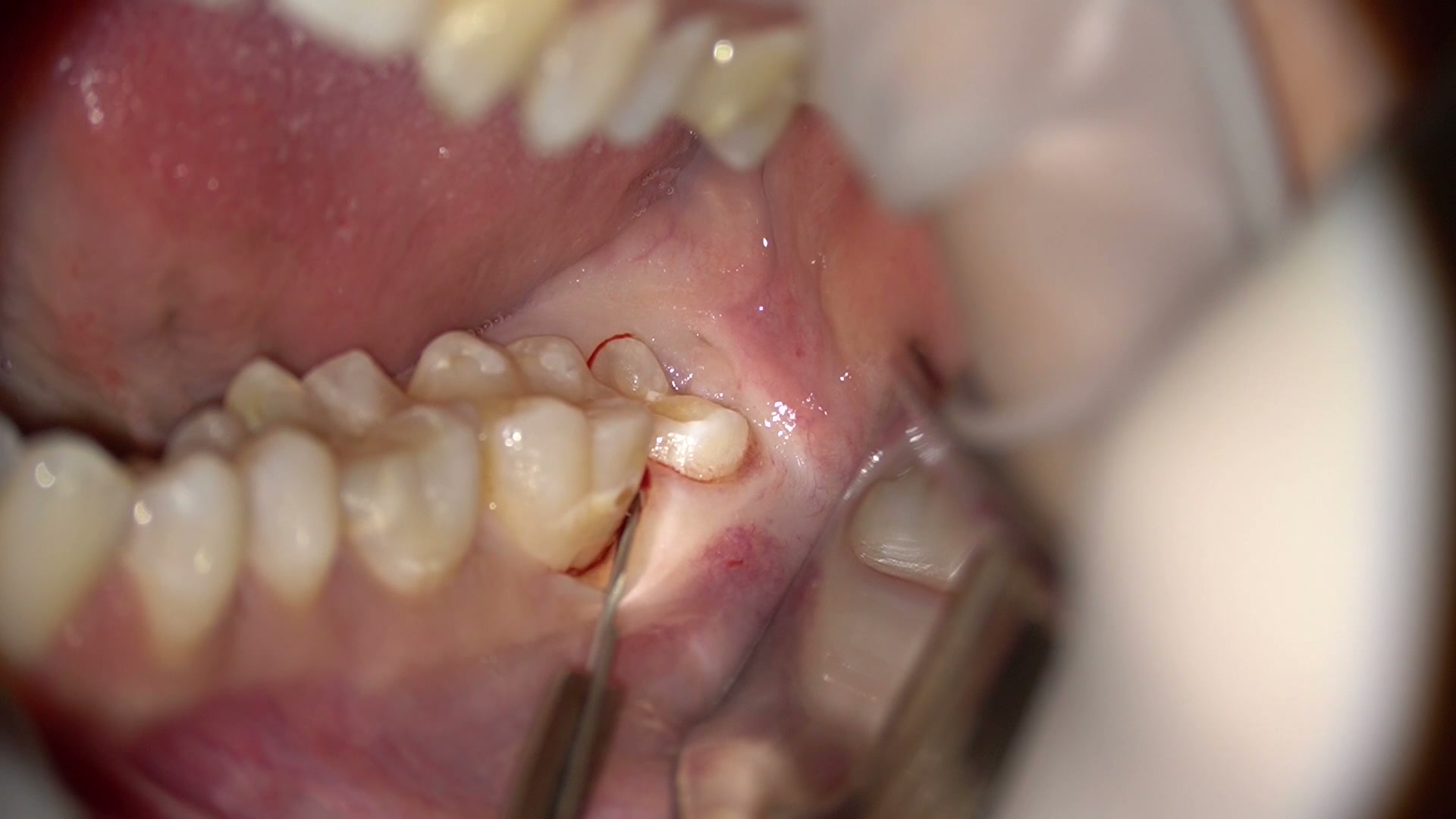 Extracción de un tercer molar semiincluido: cómo reducir la dificultad quirúrgica