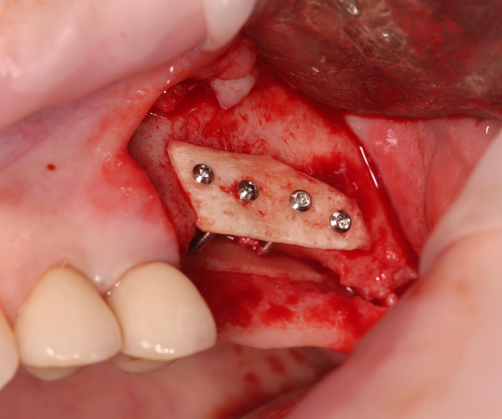 Primera laminilla ósea estabilizada con microtornillos de fijación — Microtornillos Stoma de Ancladen, colaborador de la sala.