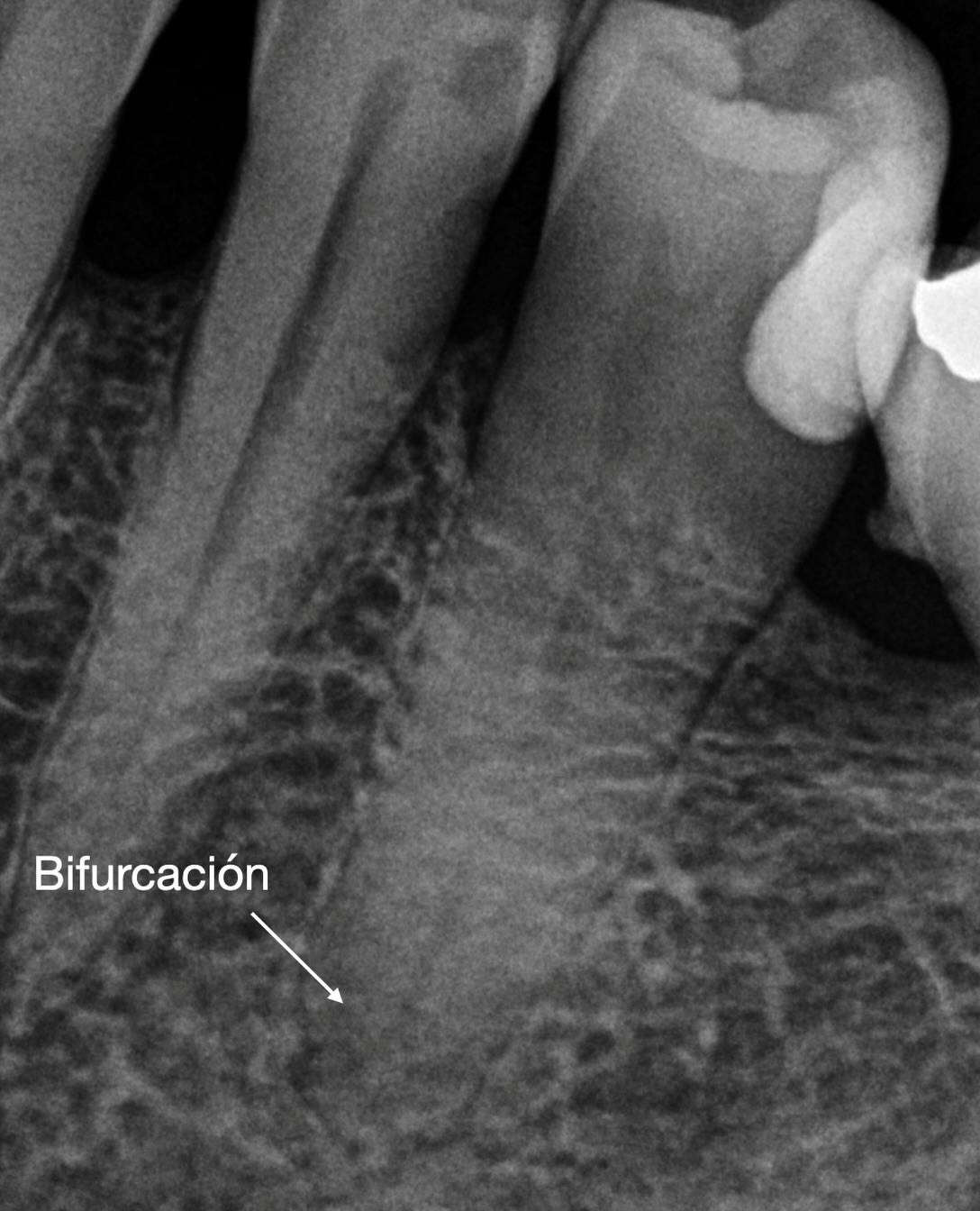 Bifurcación apical negociada con limas manuales de pequeño calibre