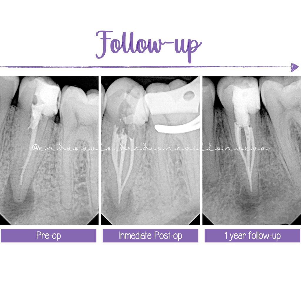 Reendodoncia microscópica del 3.4: cuando el CBCT revela una configuración 4:1