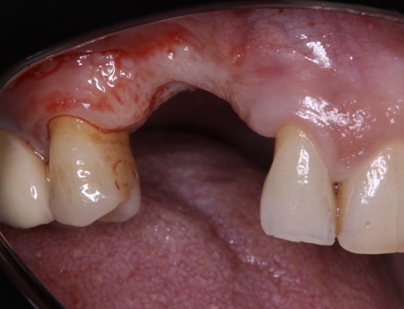 Regeneración ósea vertical con membrana no reabsorbible y colocación simultánea de implantes