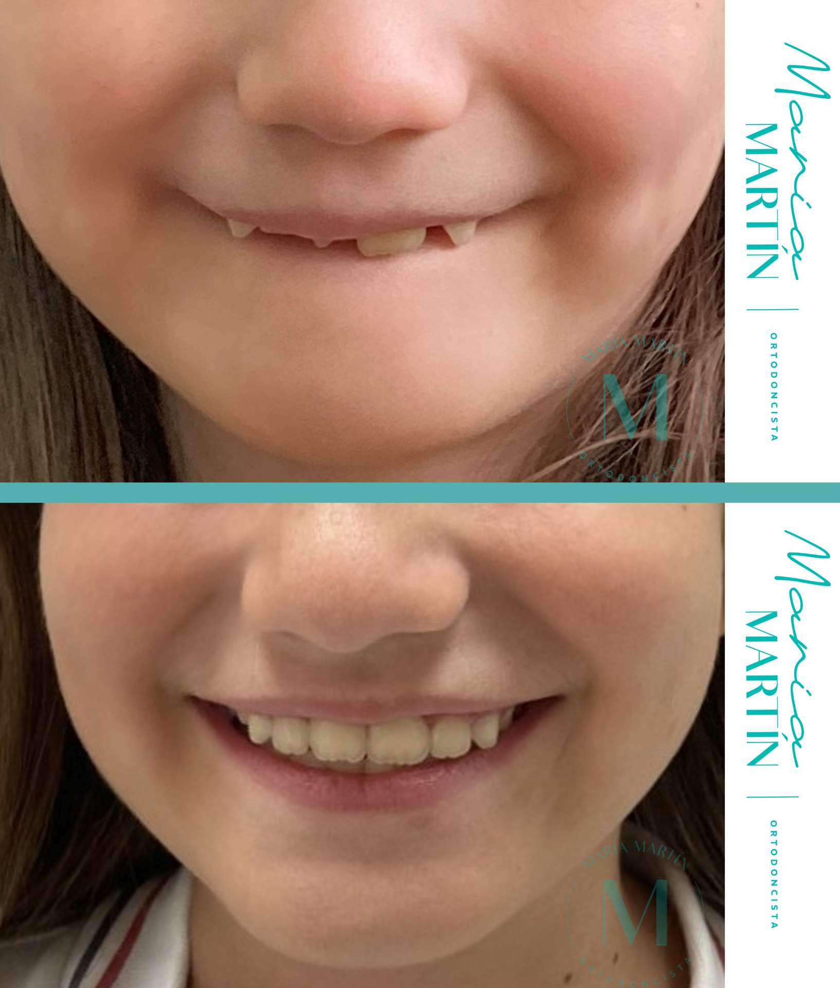 Ortodoncia interceptiva con Invisalign First: guiar el recambio antes de que el problema se instale