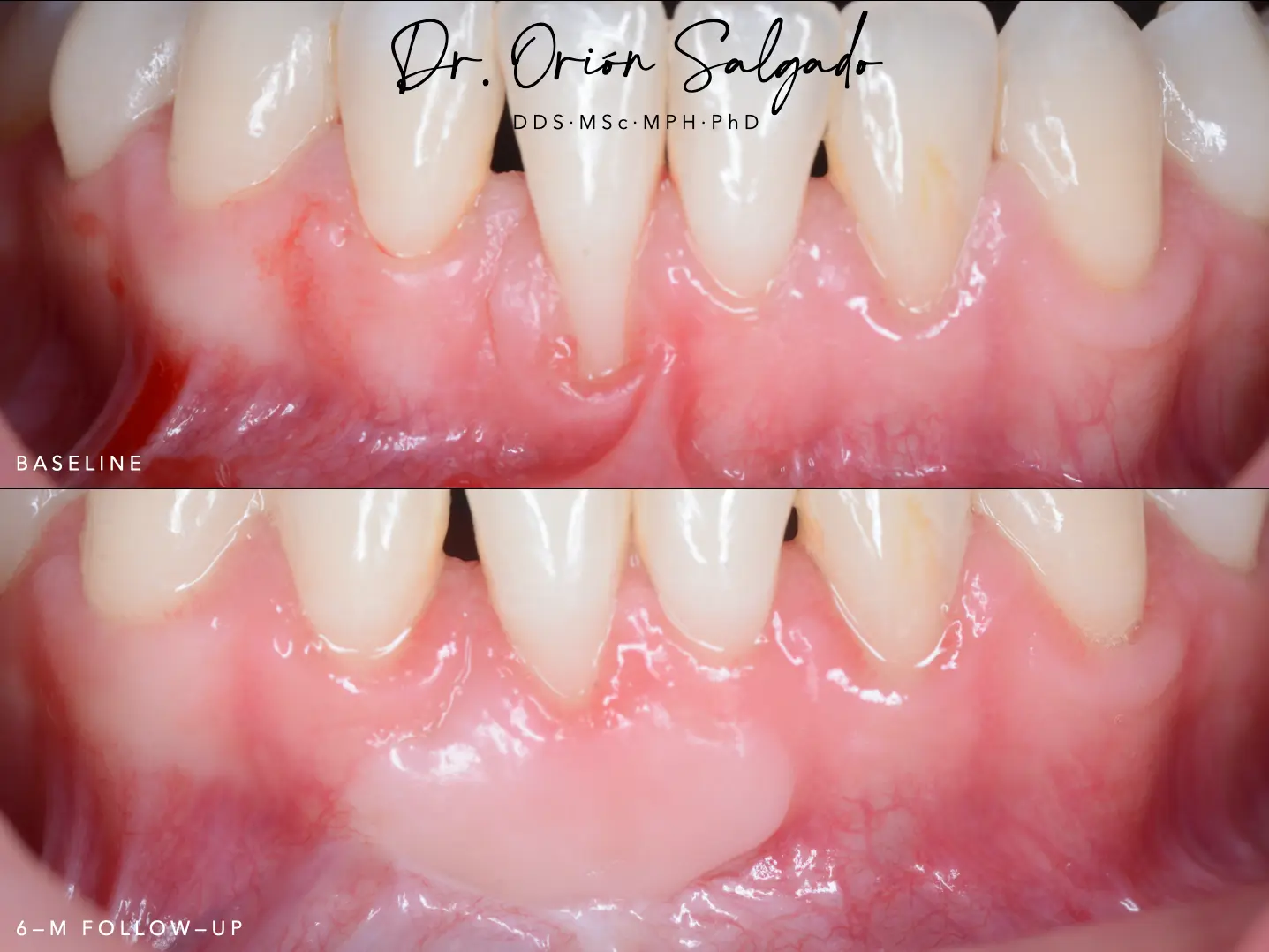 Vestibuloplastia con injerto gingival libre en el 5.º sextante: eliminar la etiología de la recesión del 4.1