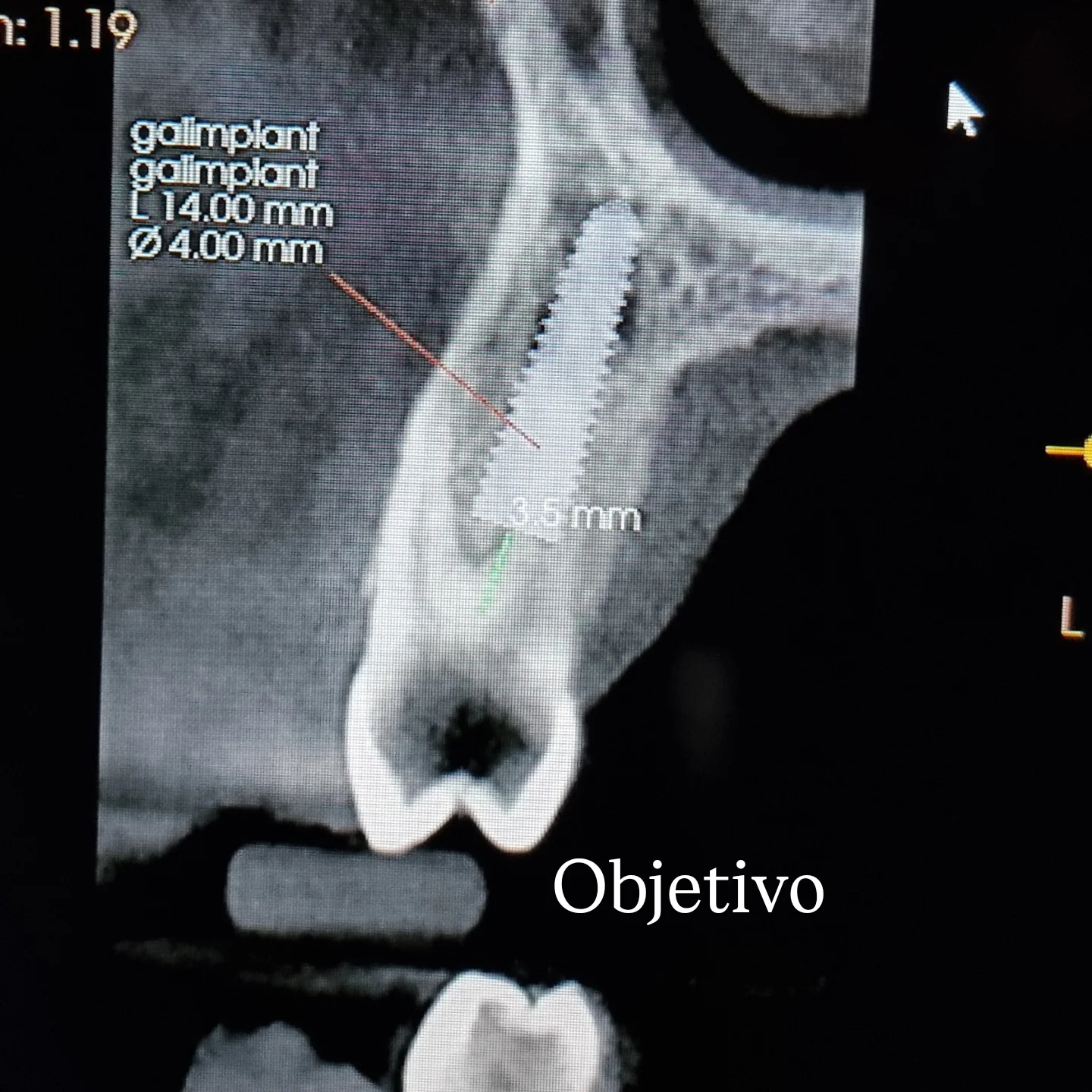 Implante postextracción con injerto alo+xeno, transmucoso y tapón personalizado