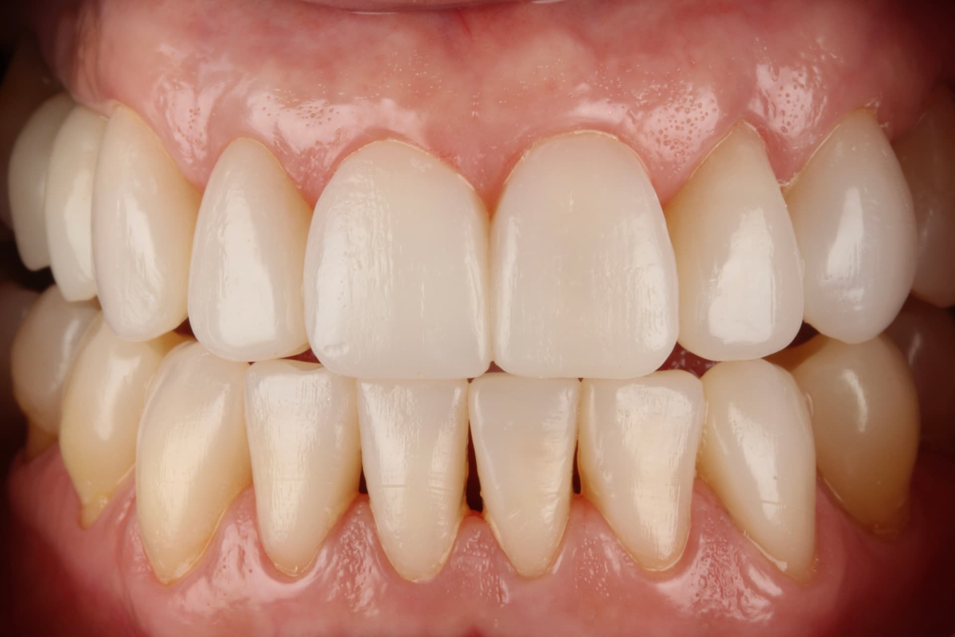 Carillas inyectadas de composite para rehabilitación estética y funcional