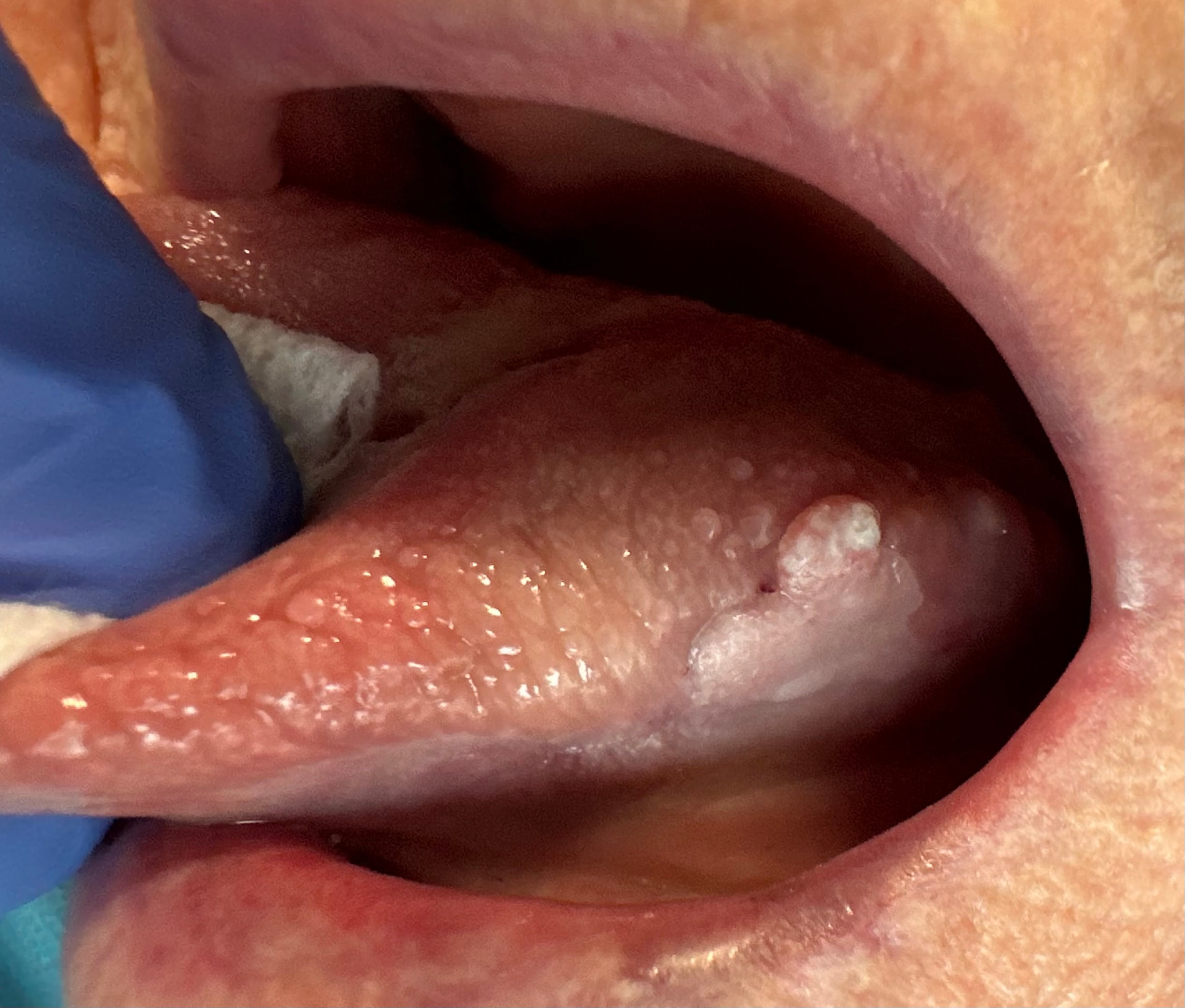 Biopsia incisional de lesión en borde lateral lingual