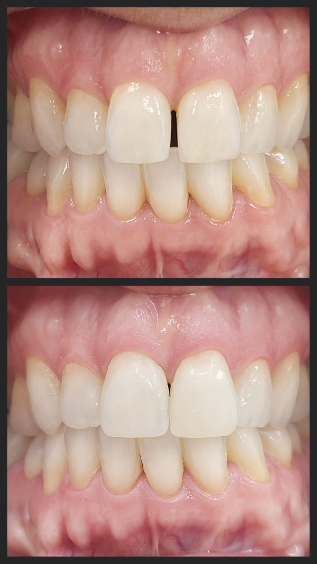 Cierre de diastema central mediante técnica de carillas inyectadas