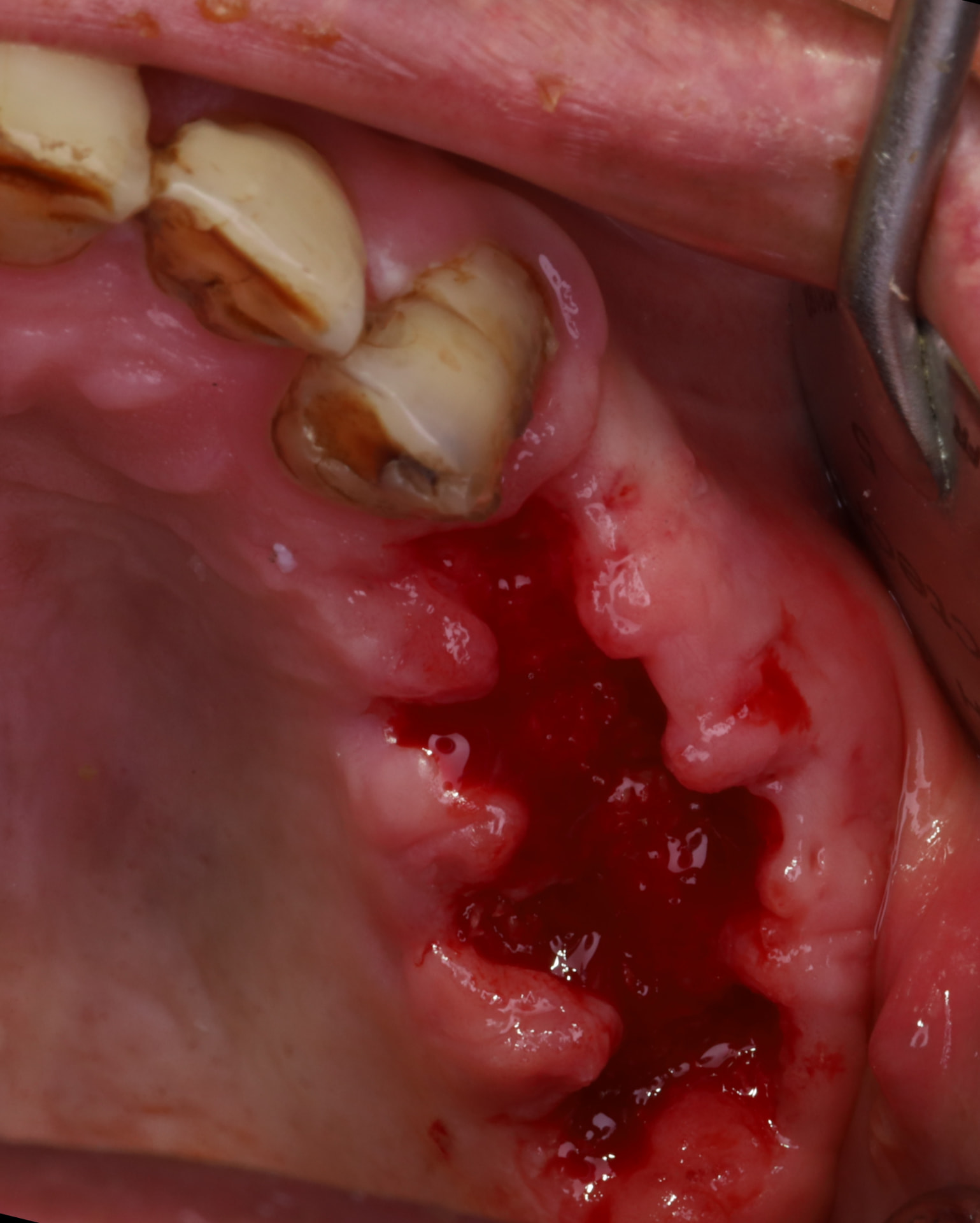Preservación alveolar con aloinjerto y cierre primario con esponja de colágeno embebida en cianoacrilato quirúrgico