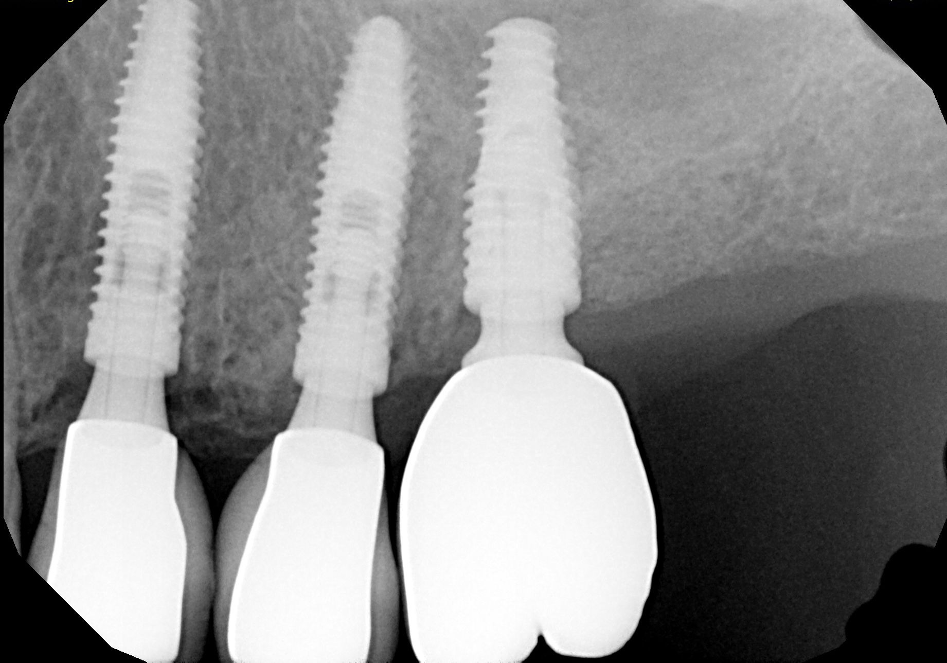 Control radiográfico final: los tres implantes con sus coronas.