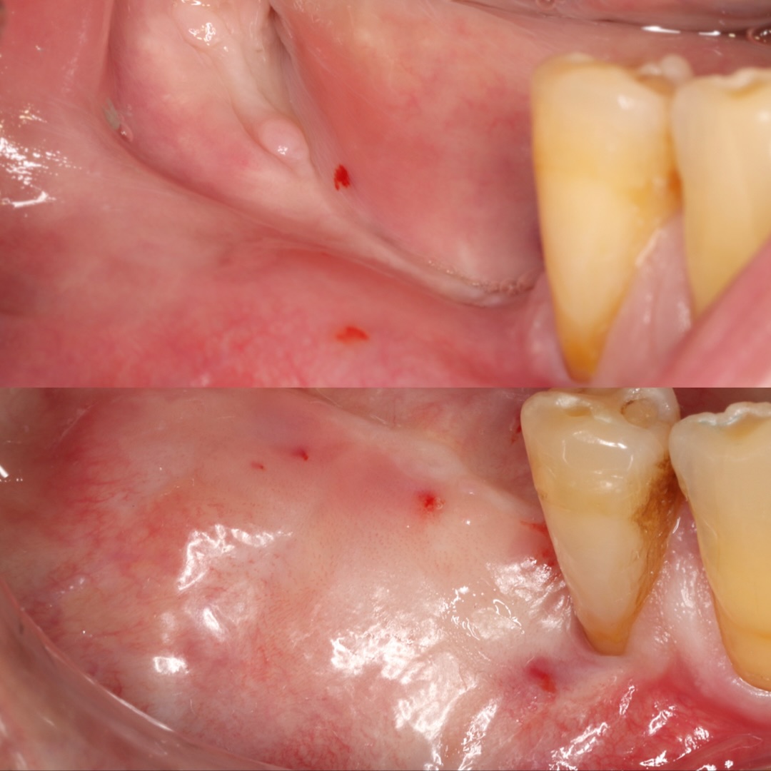 Reentrada tras regeneración ósea vertical guiada: colocación de implantes en posición protésicamente guiada