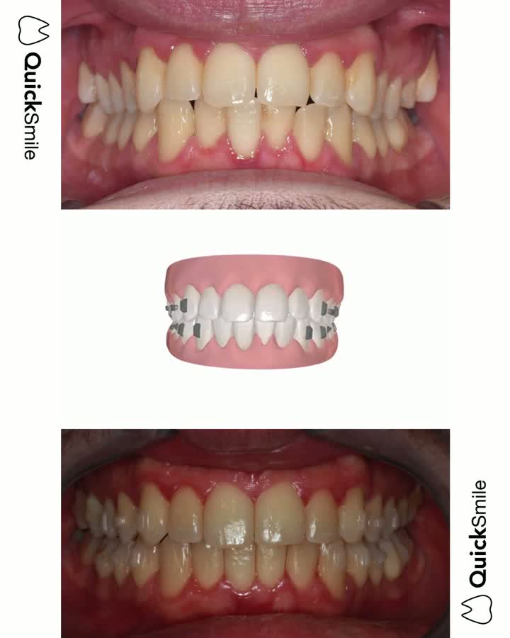 Clase I con apiñamiento y tendencia a mordida abierta: expansión dentoalveolar superior con alineadores