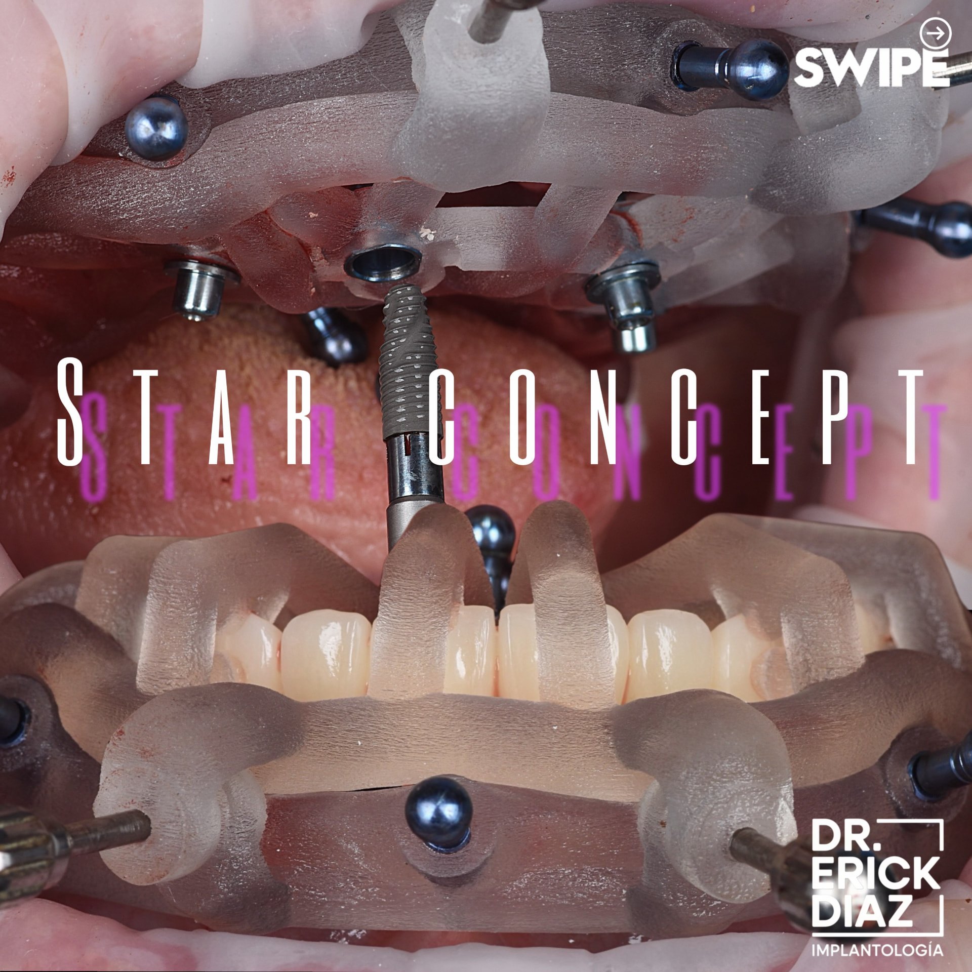 STAR Concept: rehabilitación completa guiada con placa basal, implantes y prótesis planificados en el mismo flujo