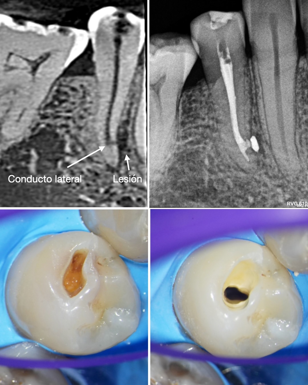 Apertura conservadora a través de la caries en un 4.5 con conducto lateral de gran tamaño y lesión laterorradicular