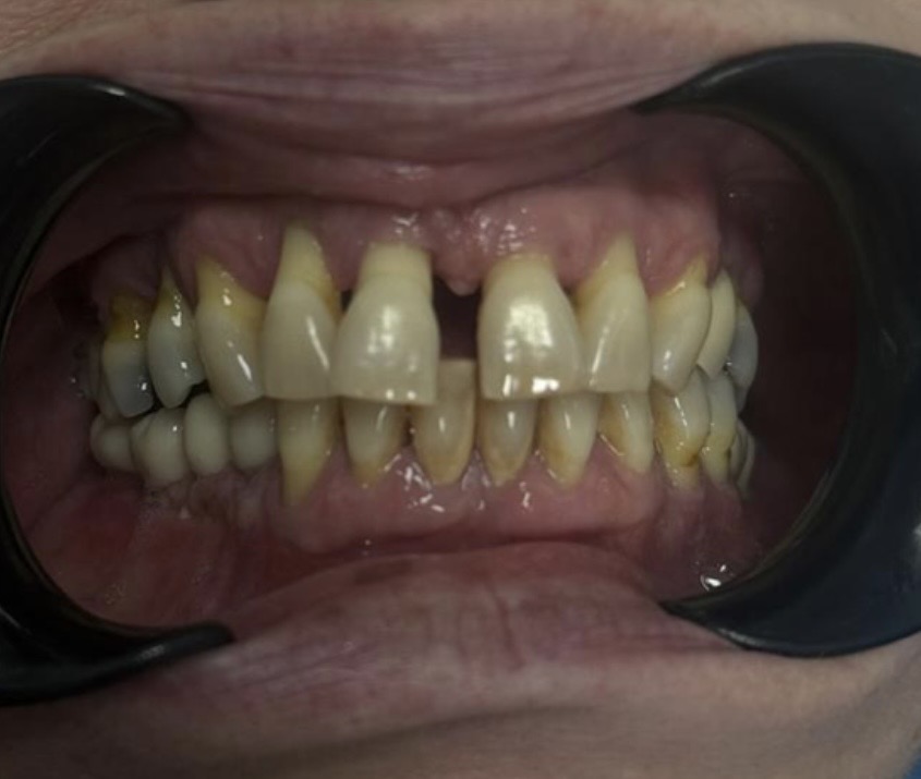 Implantes postextracción con carga inmediata en maxilar superior