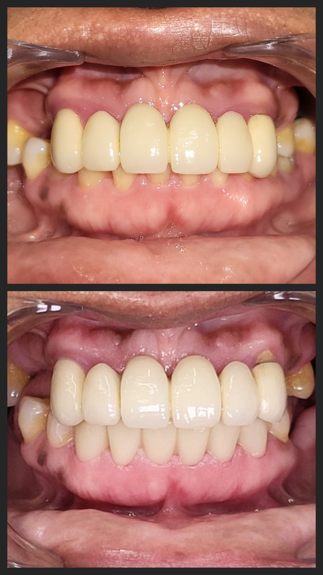Aumento de dimensión vertical: adaptación segura con provisionales de PMMA previa a implantes