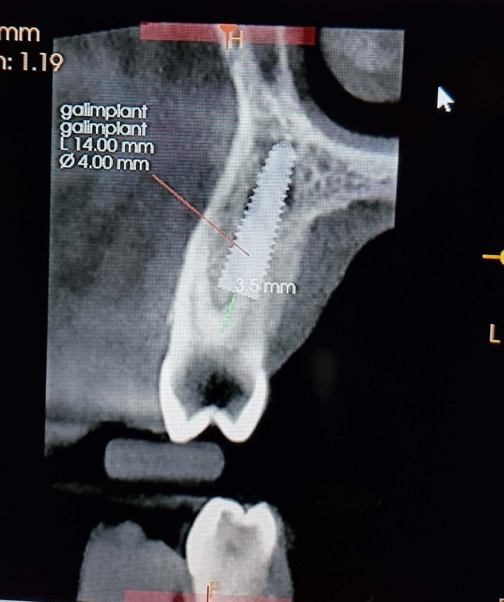 Implante postextracción de premolar superior con injerto del fresado y aloinjerto