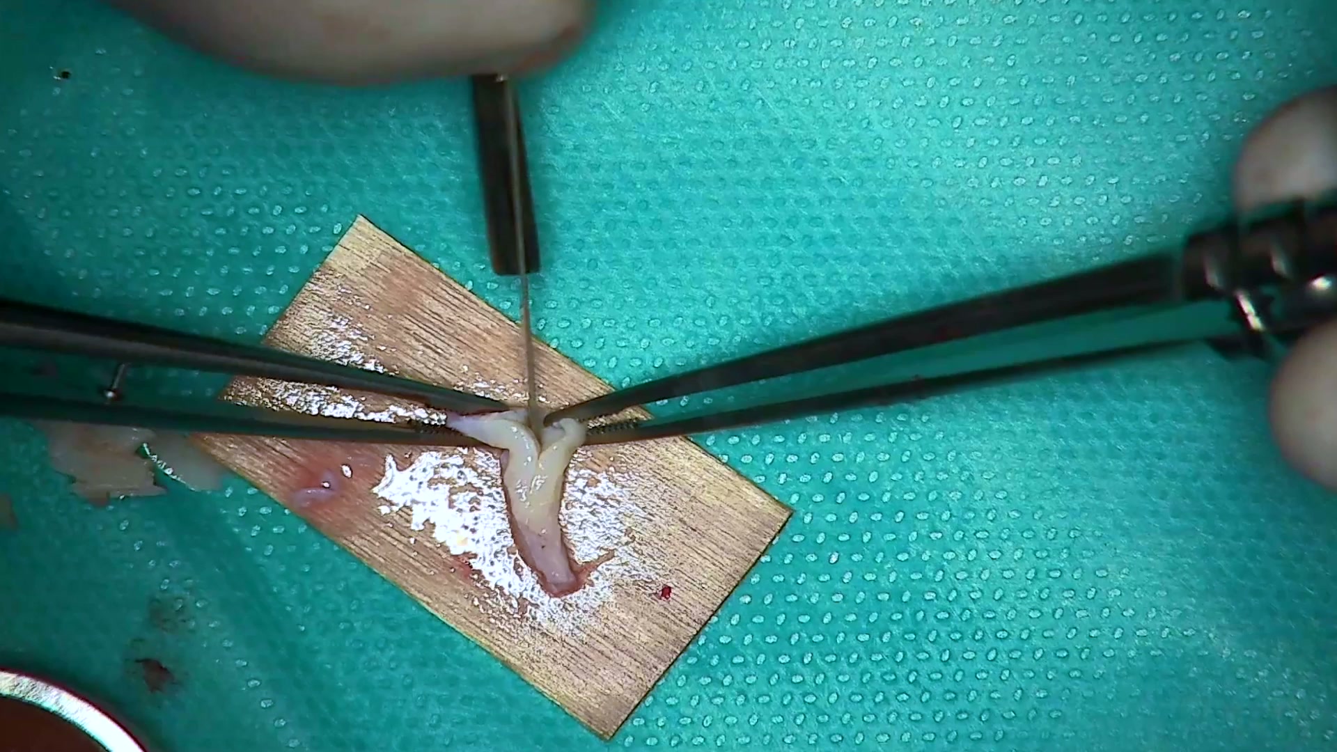 Injerto de tuberosidad desdoblado: obtener dos injertos de un único bloque