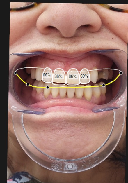 Del diseño 2D al mockup: previsibilidad estética guiada por el clínico
