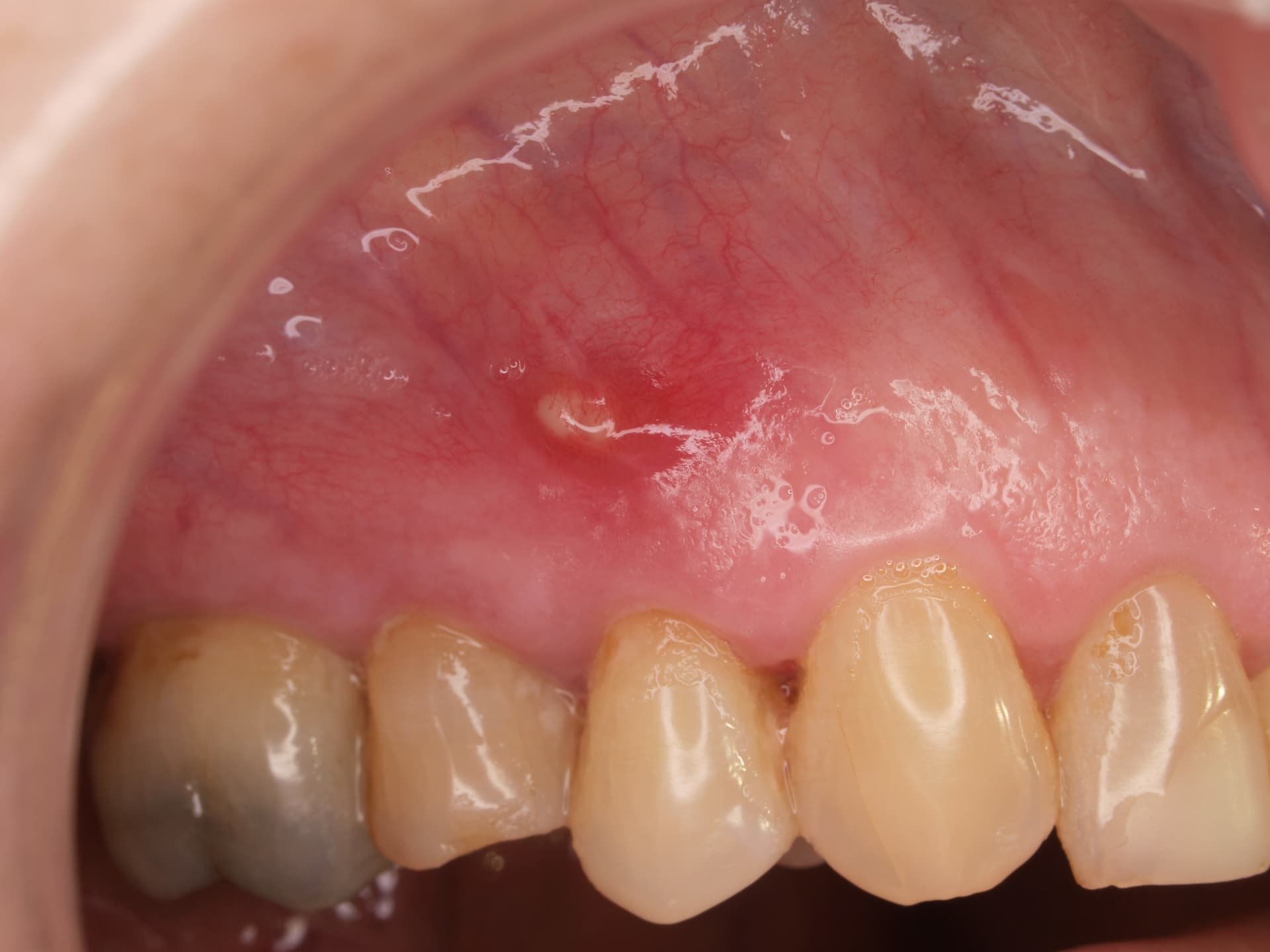Implante inmediato guiado con regeneración ósea horizontal mediante aloinjerto y membrana de colágeno fijada con chinchetas roscadas