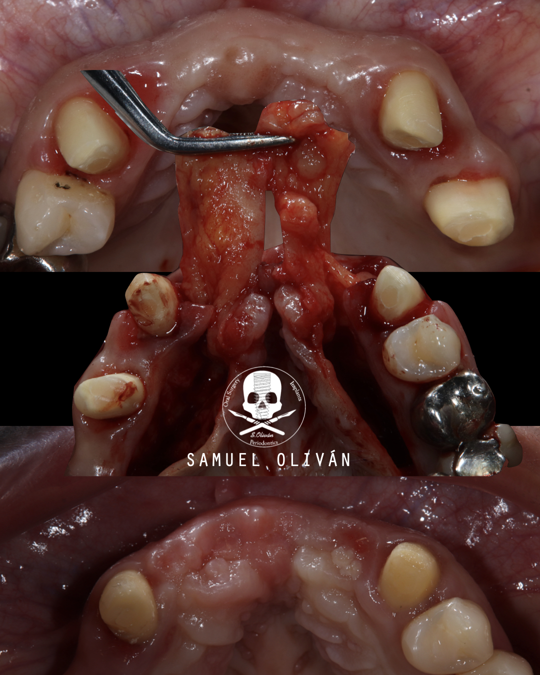 Injerto de conectivo bilateral rotado del paladar: engrosar el tejido crestal protegiendo la regeneración