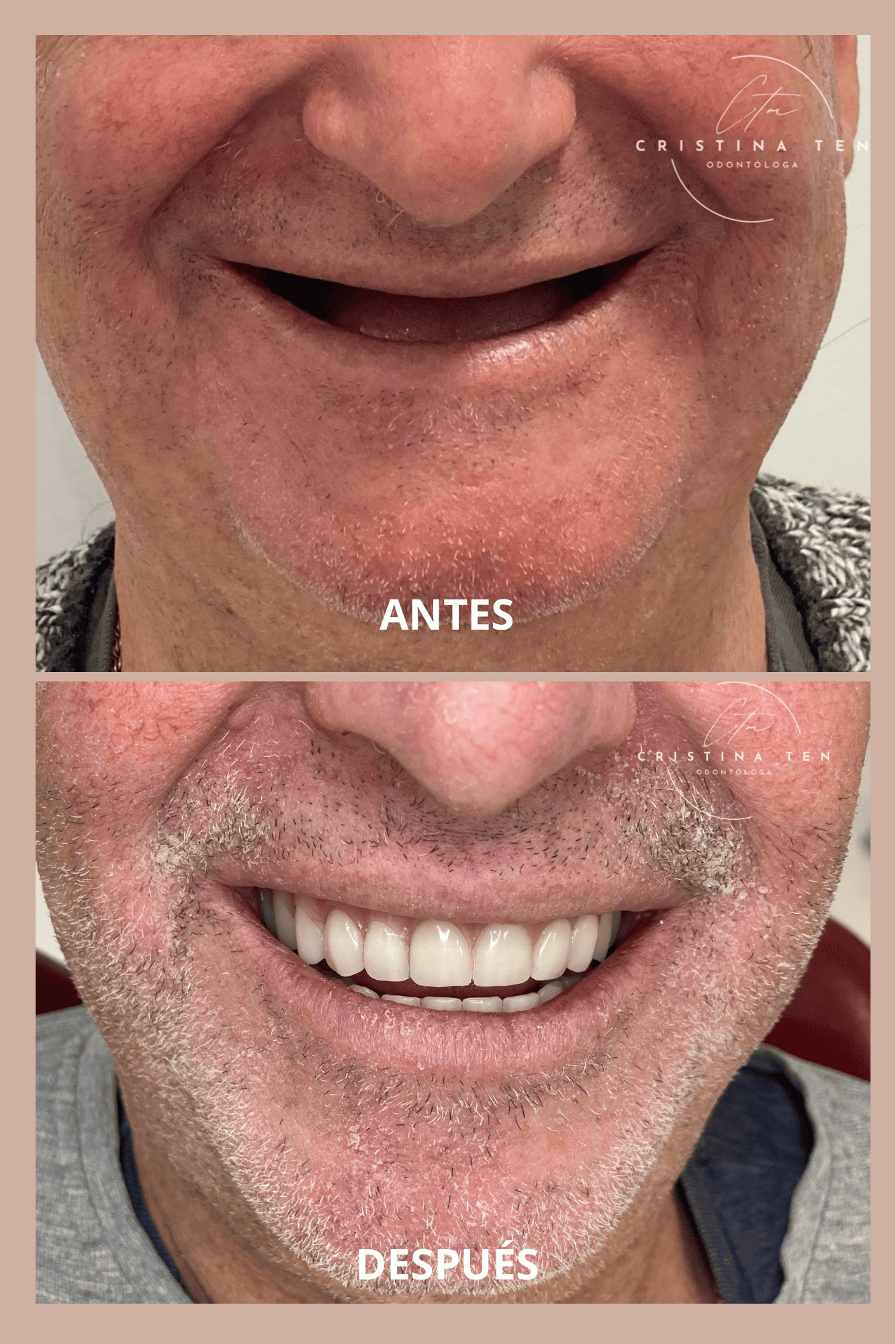 Rehabilitación oral completa en paciente edéntulo: sobredentadura mandibular sobre cuatro implantes con sistema Locator