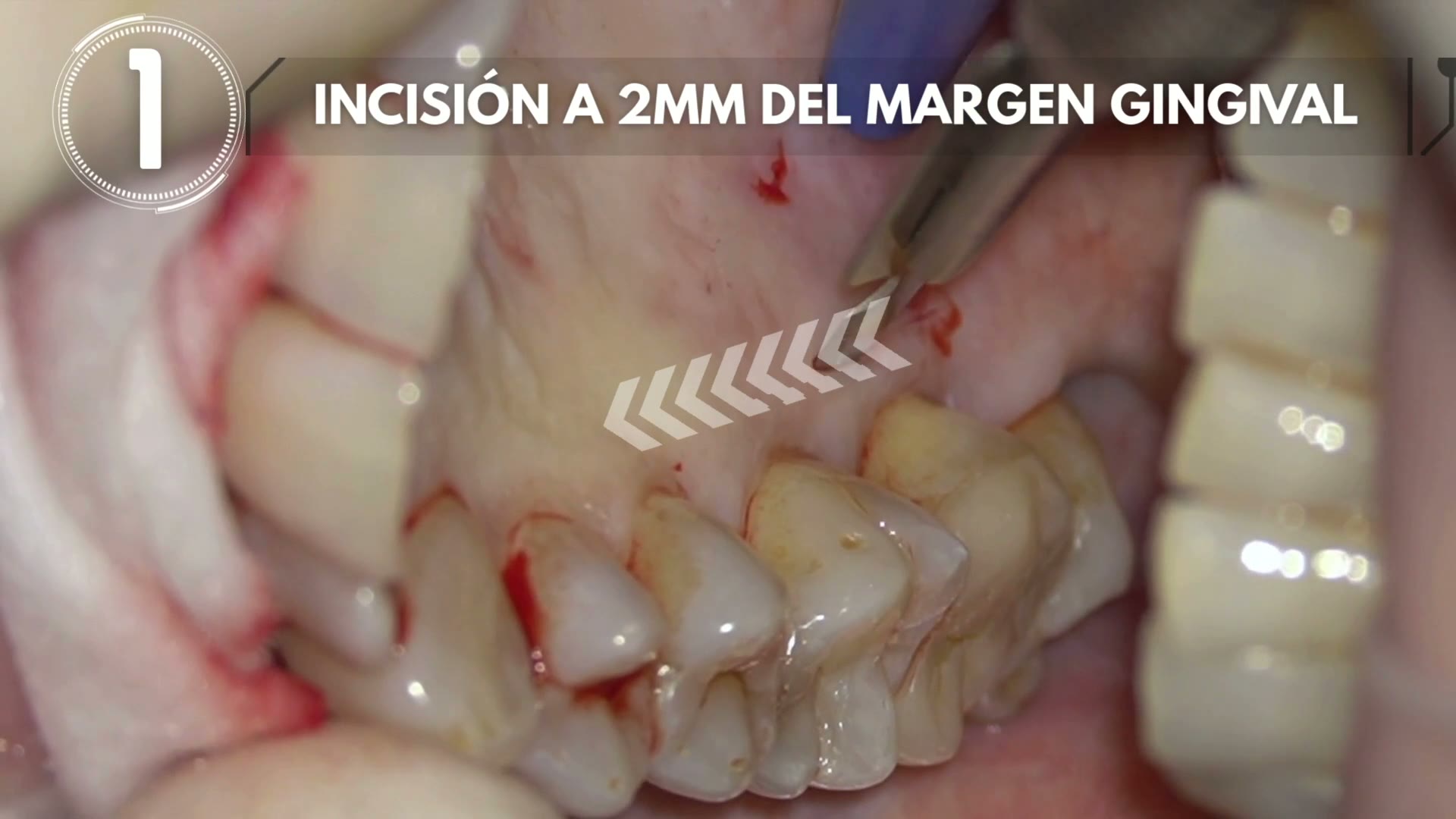 Toma de injerto palatino y desepitelización con fresa de diamante