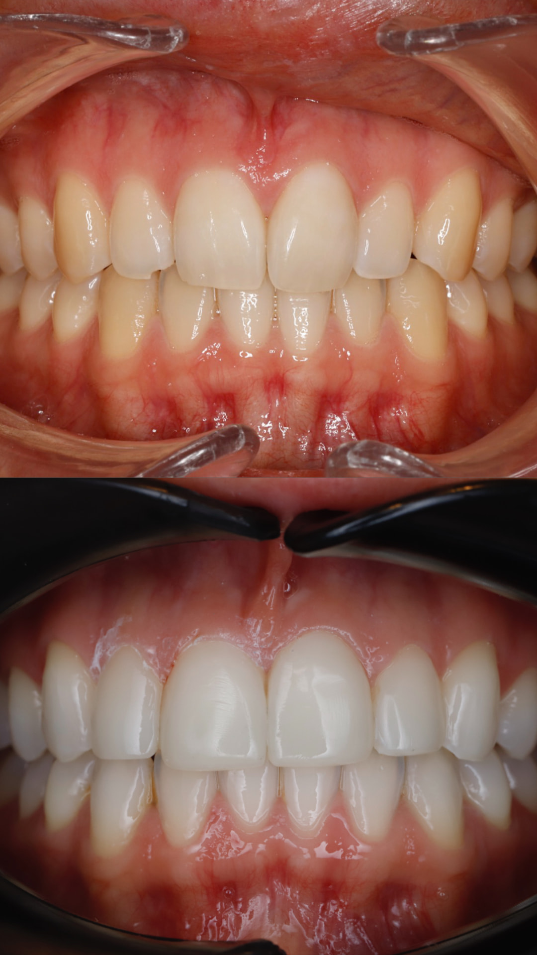 Secuencia estética integral: ortodoncia invisible, blanqueamiento y carillas de composite