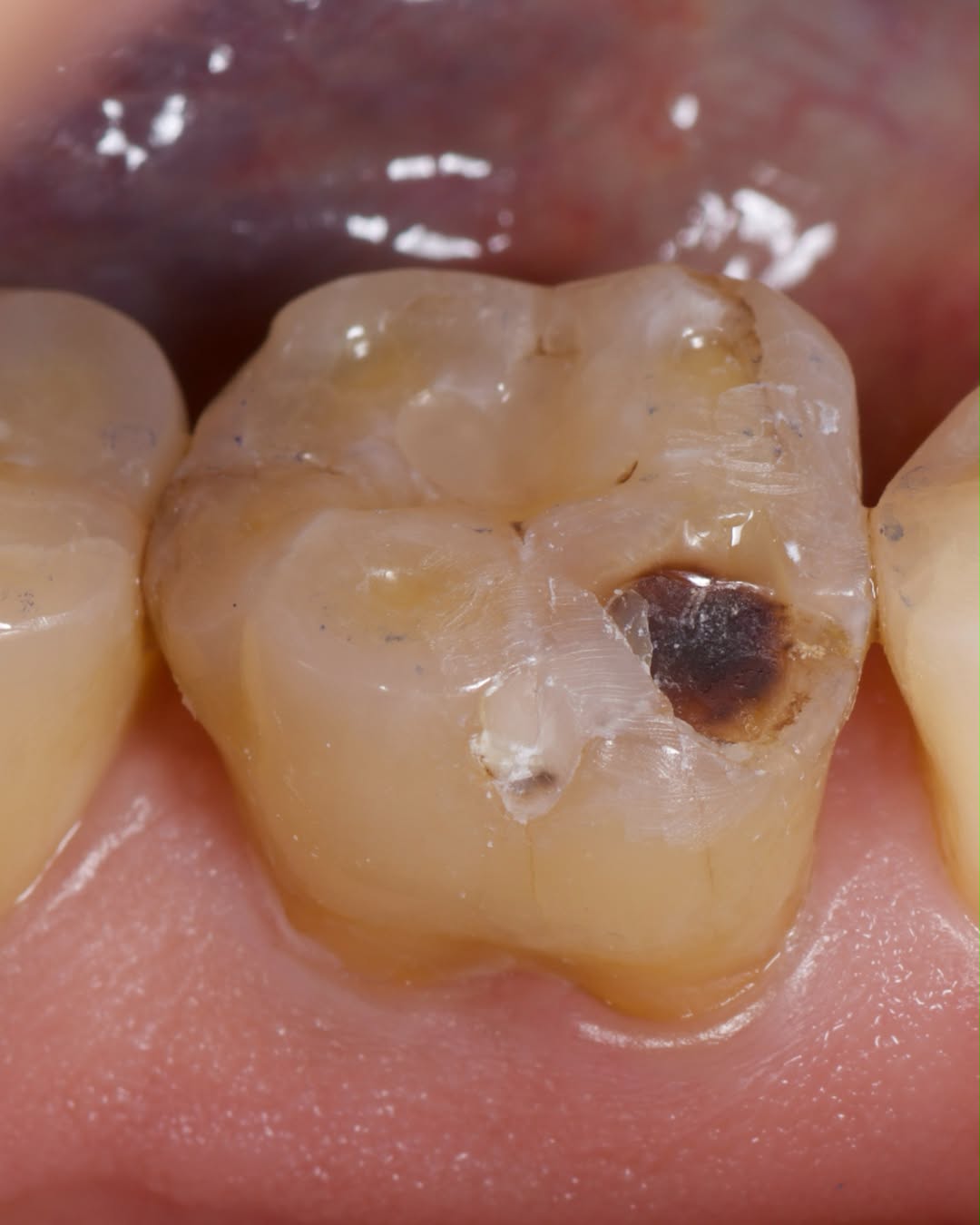 Craze lines o crack: restauración directa conservadora en un molar sin cobertura cuspídea