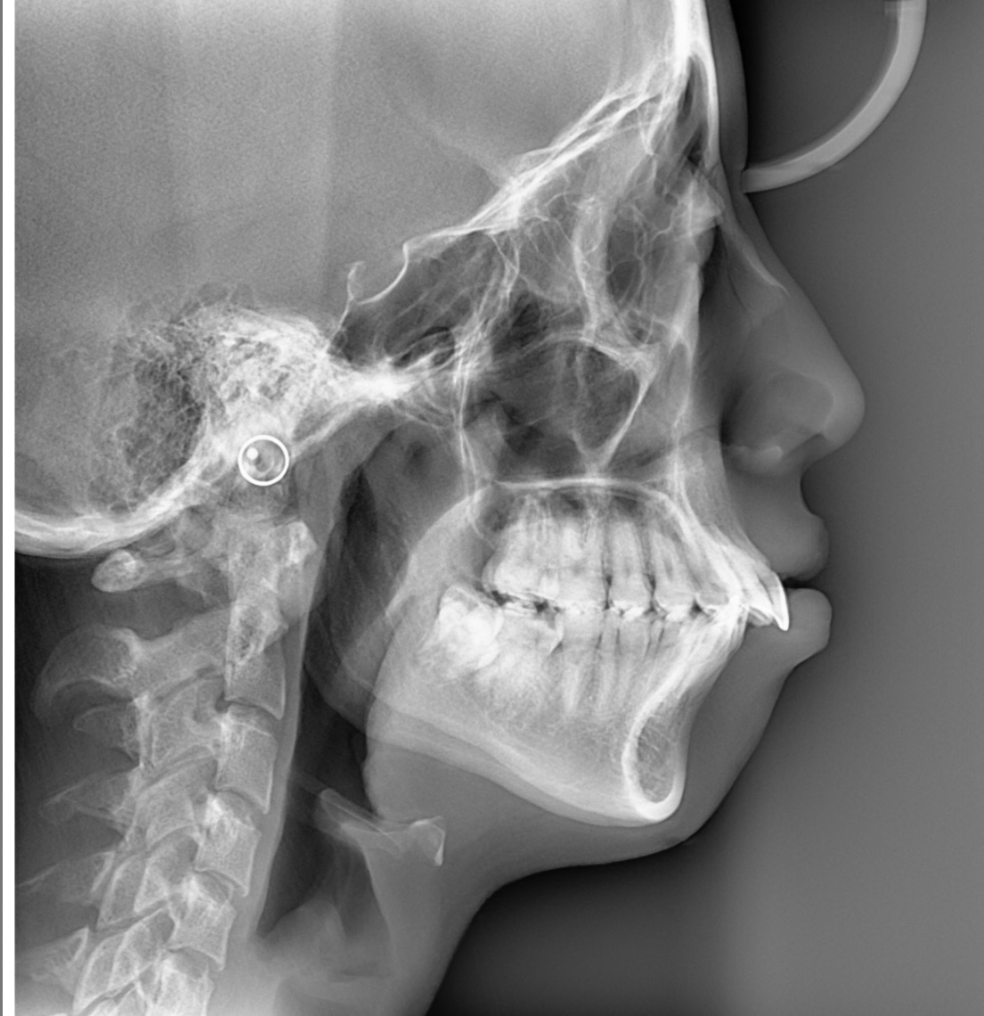 Reeducación miofuncional como moduladora del crecimiento craneofacial