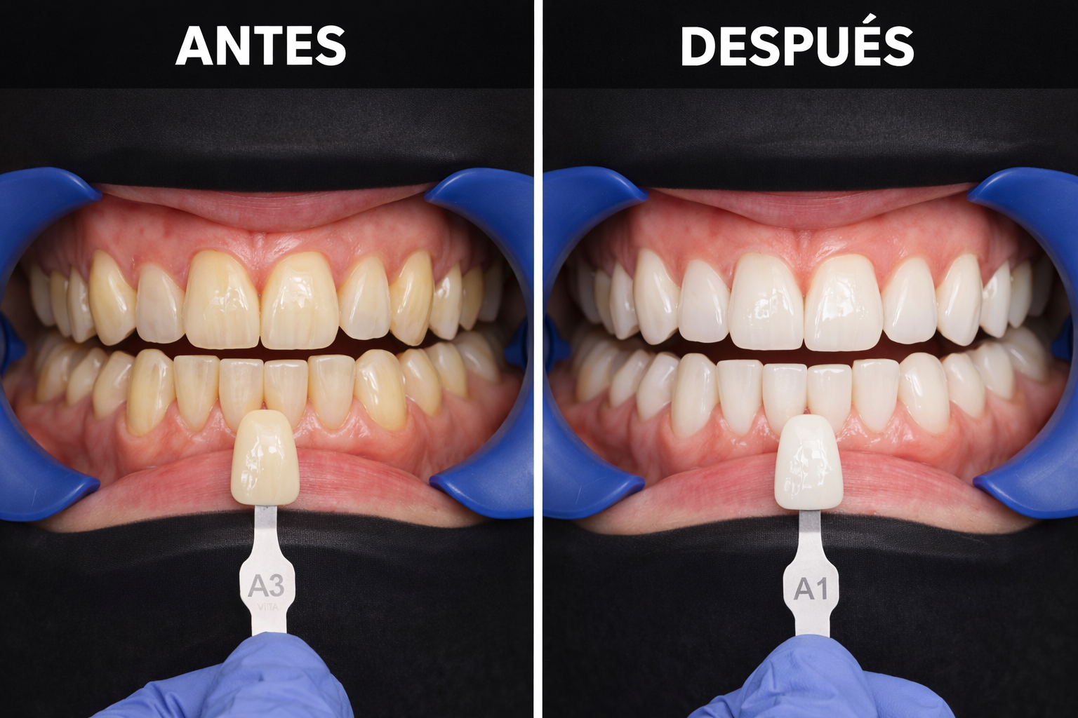 Blanqueamiento dental vital con láser de diodo: de A3 a A1