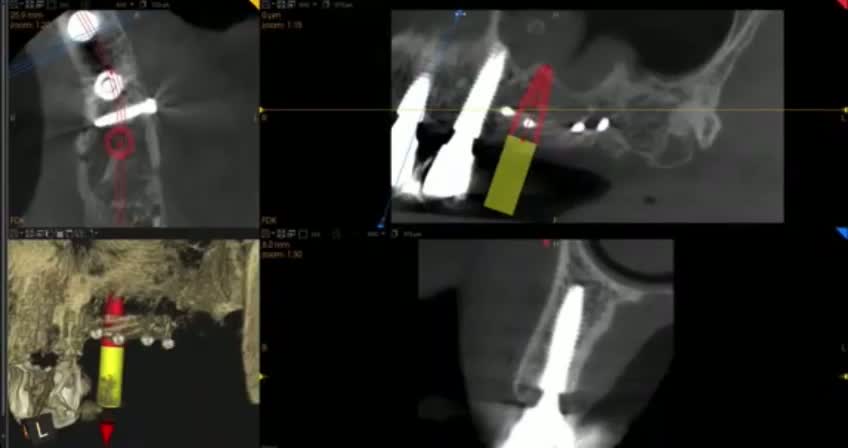 Radiografía del resultado regenerativo.