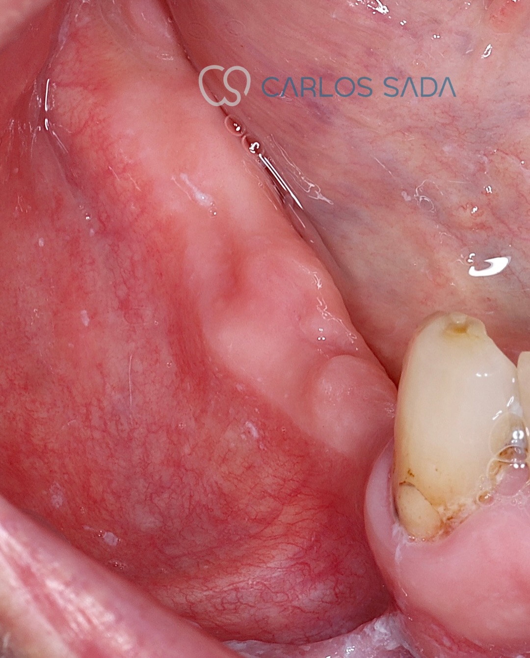 Regeneración ósea horizontal en mandíbula posterior atrófica con técnica de salchicha