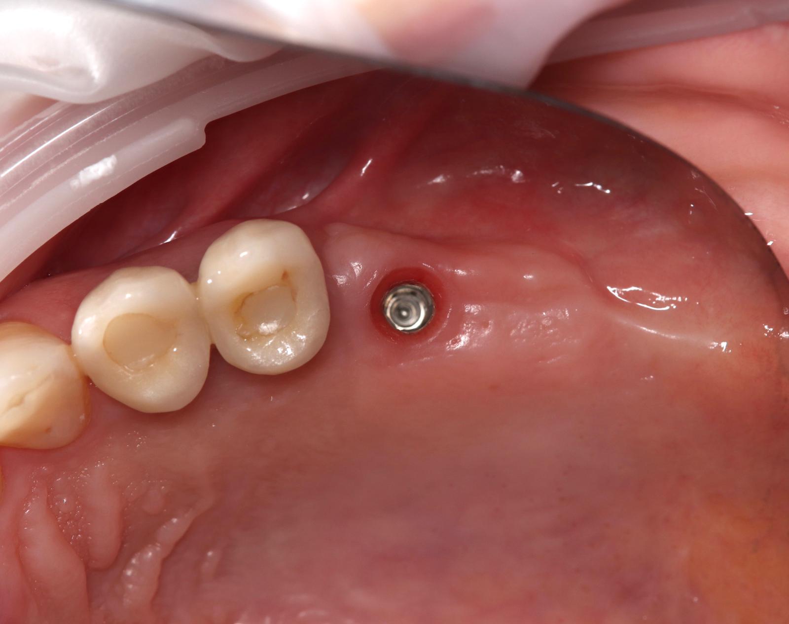 Cicatrización de tejidos blandos alrededor del pilar, en vista oclusal.
