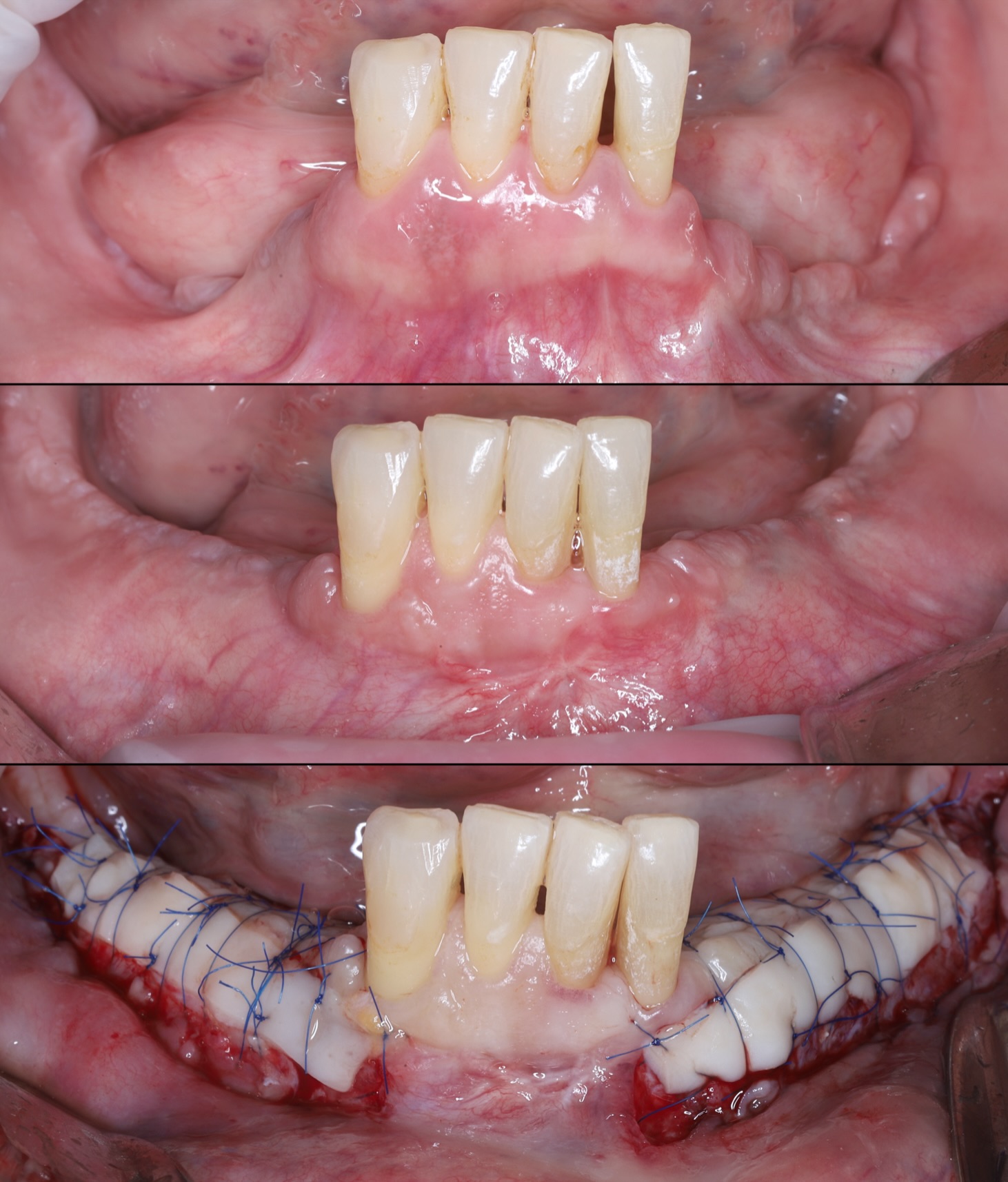 Reconstrucción mandibular vertical con malla de titanio a medida e injerto de banco